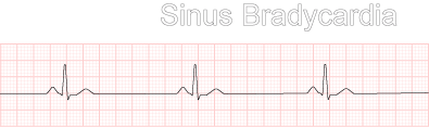 Diagram of a Sinus Bradycardia rhythm