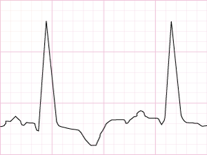 Sinus Tachycardia (close up)