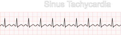 Diagram of a Sinus Tachycardia rhythm