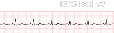 Rhythm strip of sinus rhythm recorded from ECG lead V6