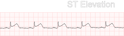 ST Elevation