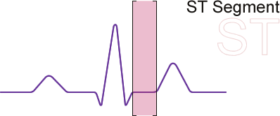 ST Segment