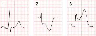 Image: ST Segment - 1. Normal, 2. Depressed, 3. Elevated