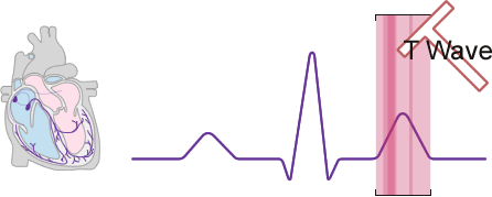 Diagram of the T wave section of the sinus wave