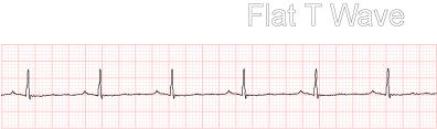 Flat T Wave