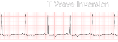 T Wave Invesion