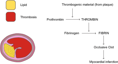 Thrombosis