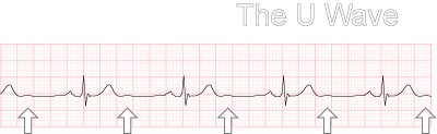 ECG displaying U waves