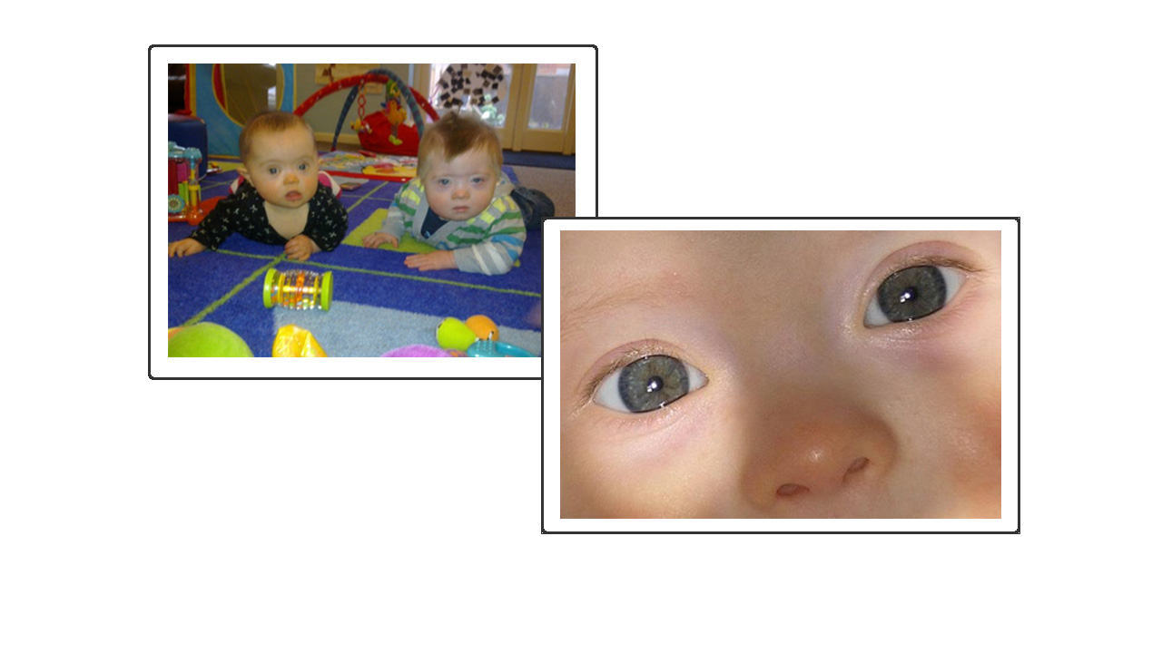 a picture of 2 children with Down's Syndrome sitting together and a close up of a babies eyes.