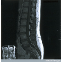 Show Bilateral sciatica Image