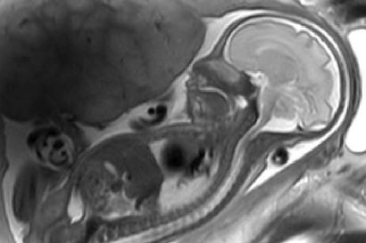 Placenta MRI research